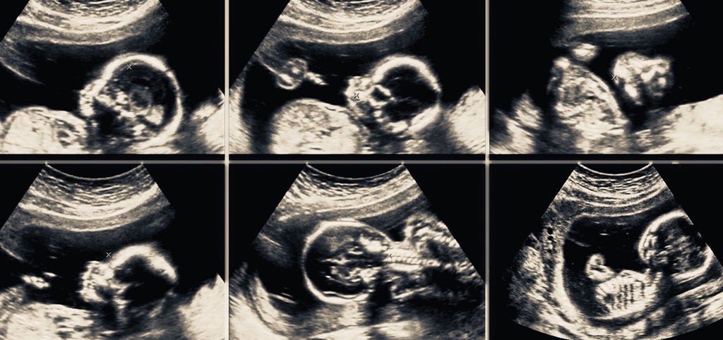 Fruchtwasseruntersuchung: Gründe, Ablauf, Ergebnisse und Risiken